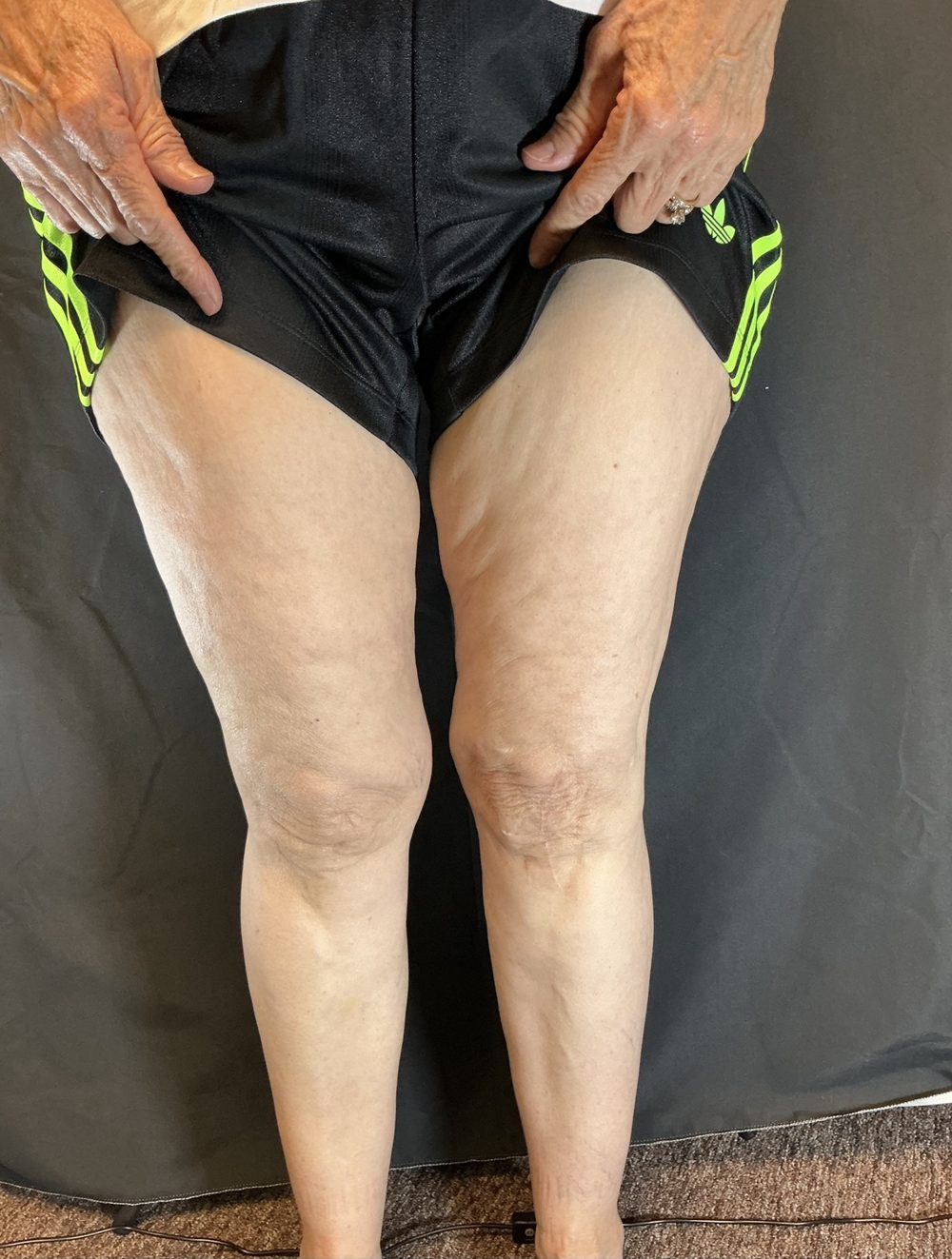 Front view of the same client’s thighs after Morpheus8 treatment