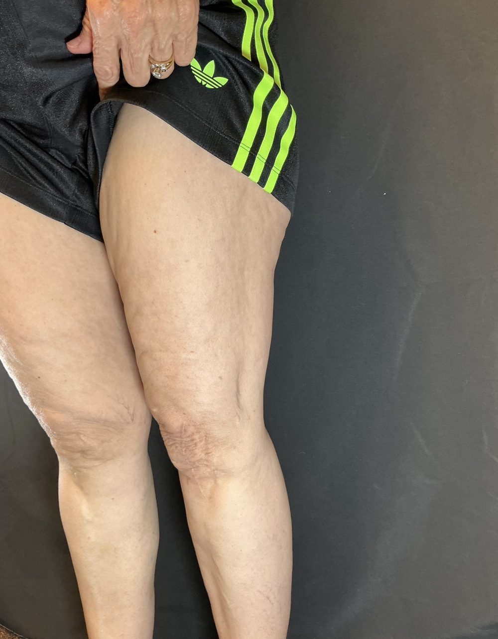 Front view of the same client’s thighs after Morpheus8 treatment, second angle