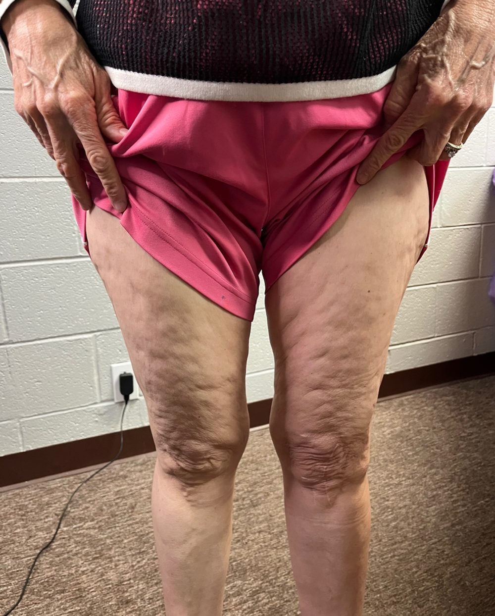 Front view of a client’s thighs before Morpheus8 treatment