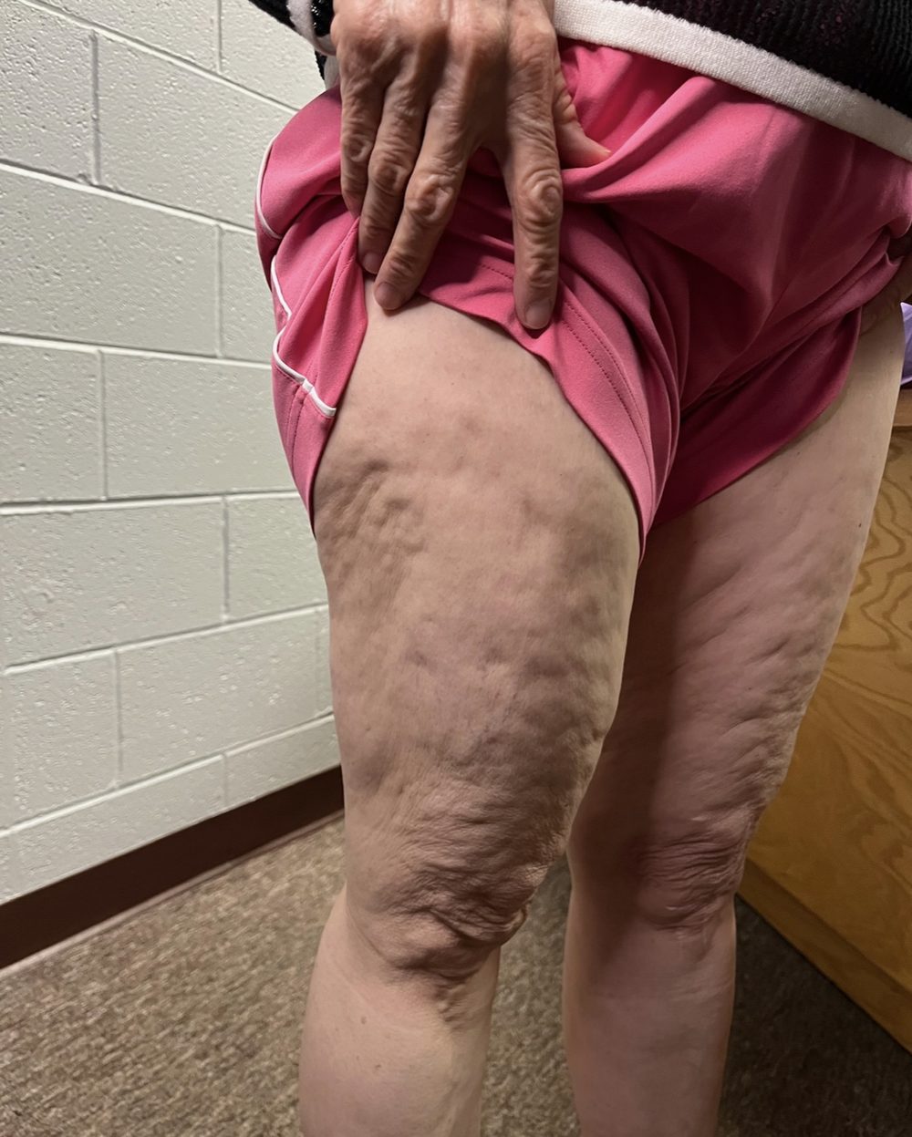 Front view of a client’s thighs before Morpheus8 treatment, second angle
