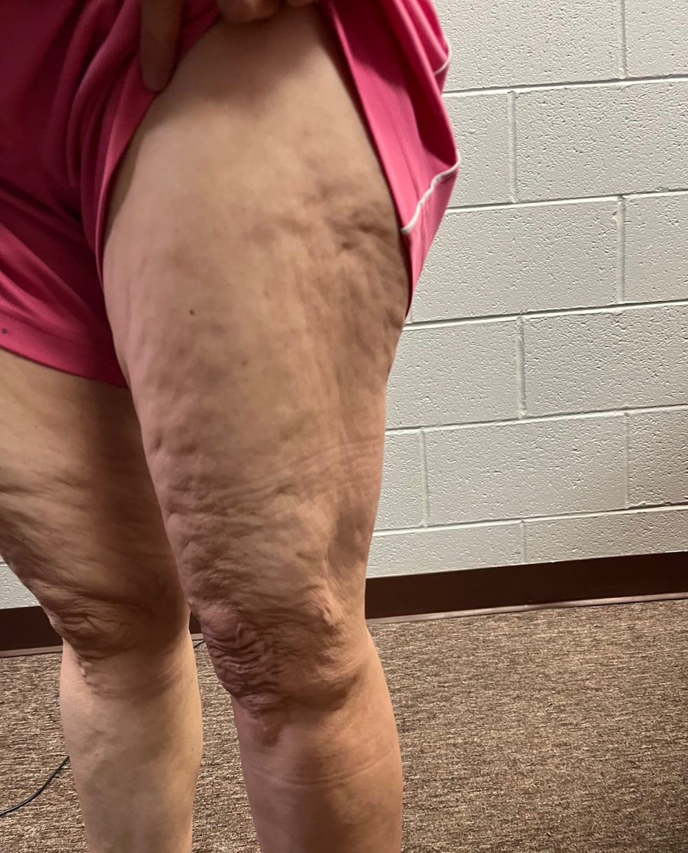 Side view of a client’s thigh before Morpheus8 treatment