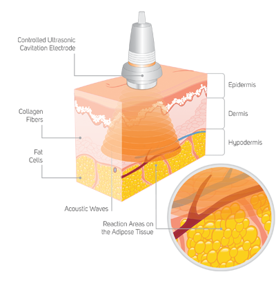 cavitation ultrasound ultrasonic utilized unborn