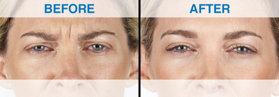 A woman 's eyes before and after using the new procedure.